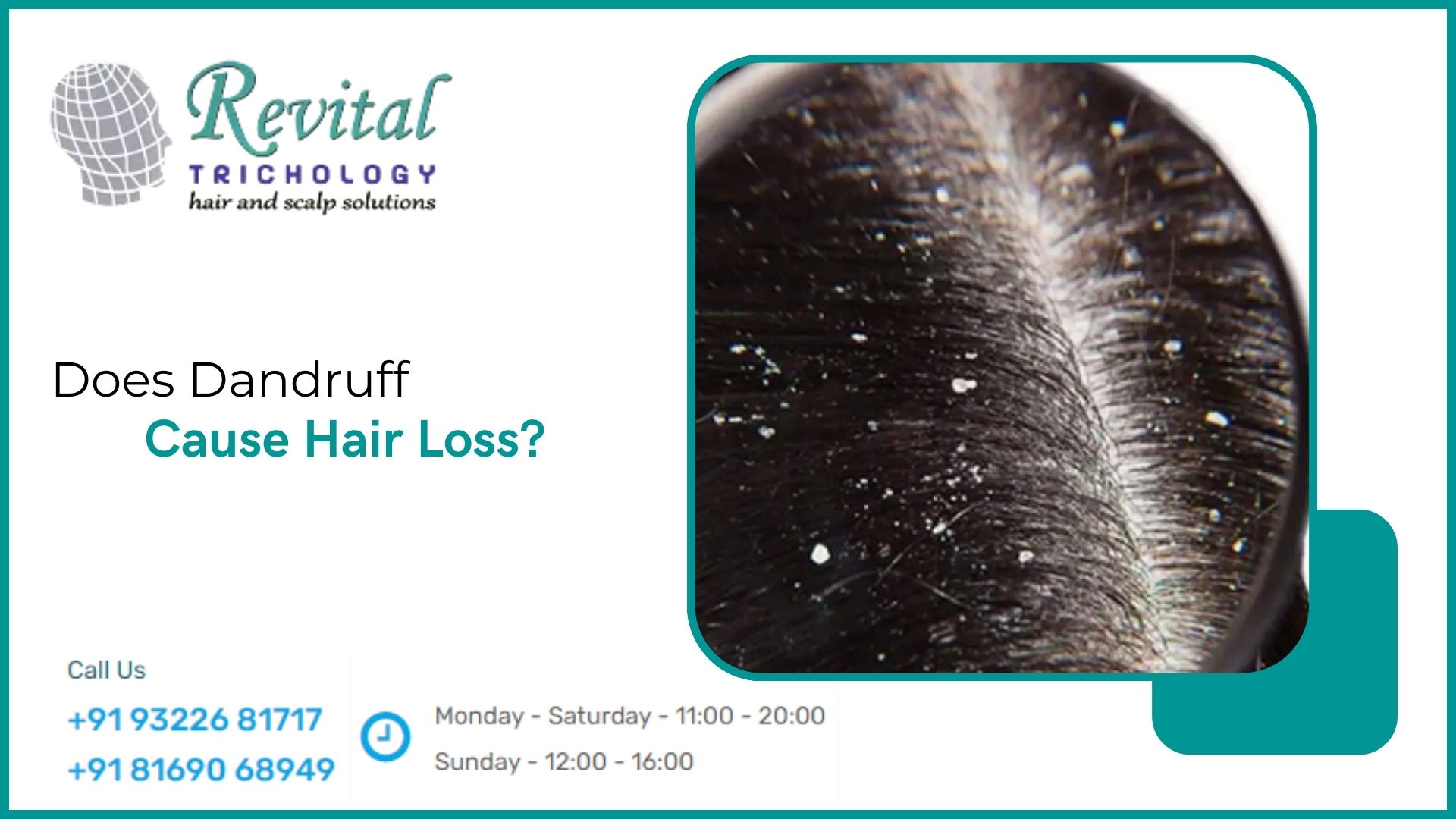 Can Dandruff Cause Hair to Fall Out?