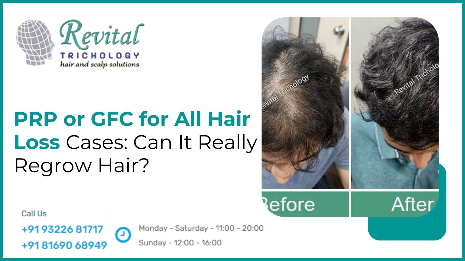 Is PRP or GFC Indicated for All Hair Loss Cases, and Can It Really Regrow Hair?