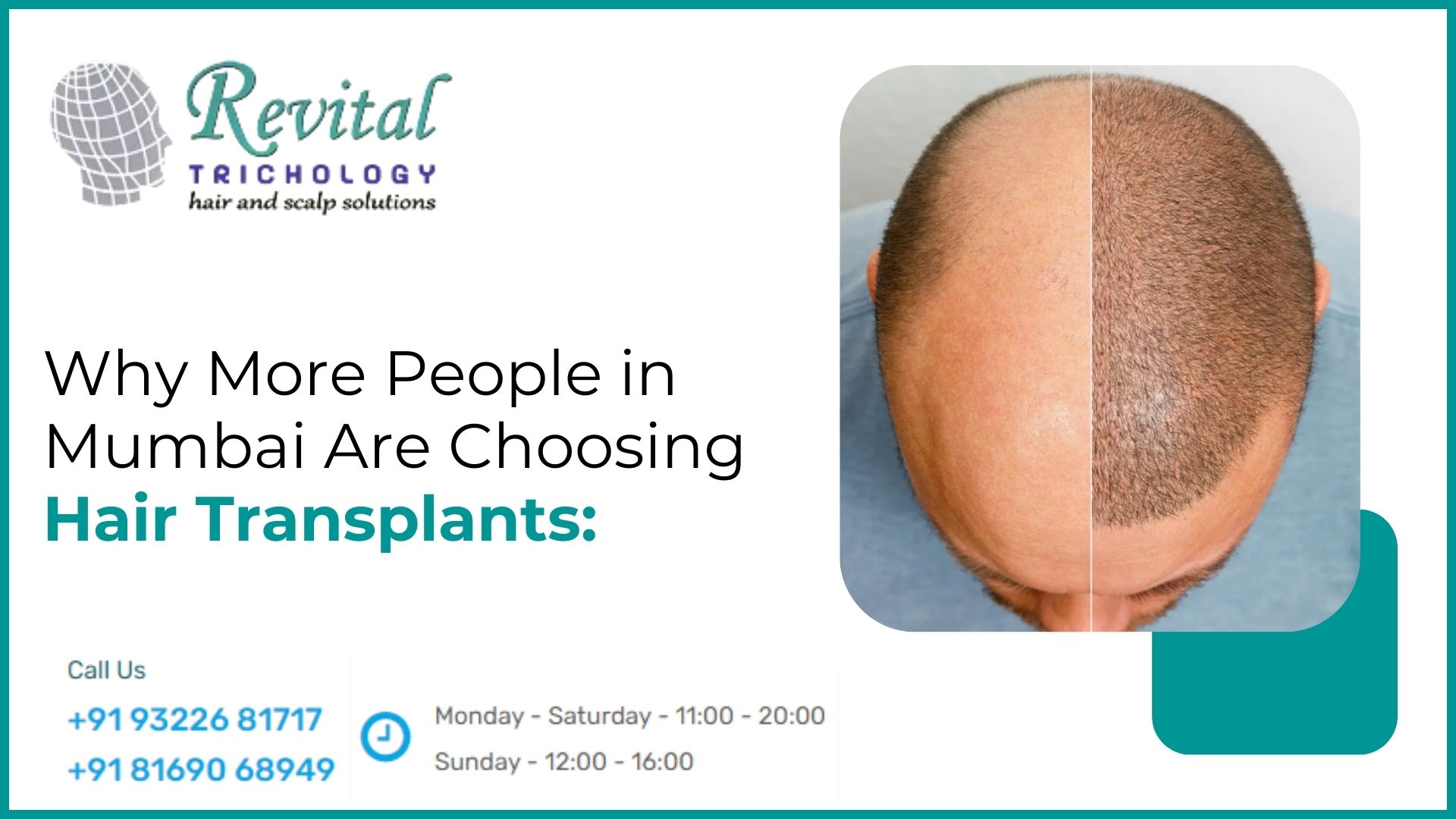 Why More People in Mumbai Choose Hair Transplants & Why